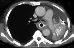 Stent Through Esophageal Cancer Which Invades Hilum of Lung - CTisus CT Scan