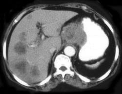 Esophageal Cancer With Nodes and Liver Metastases - CTisus CT Scan