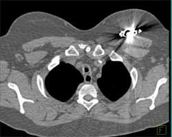 Fistulae of Esophagus to Trachea - CTisus CT Scan