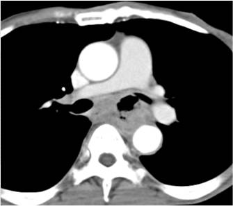 Esophageal Cancer with T-E Fistulae and Bulky Tumor - CTisus CT Scan