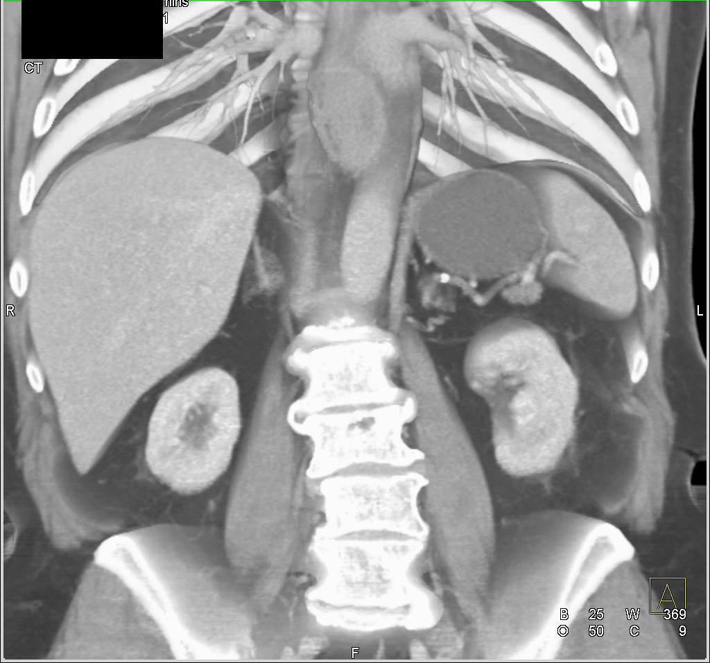 Esophageal Cancer - CTisus CT Scan