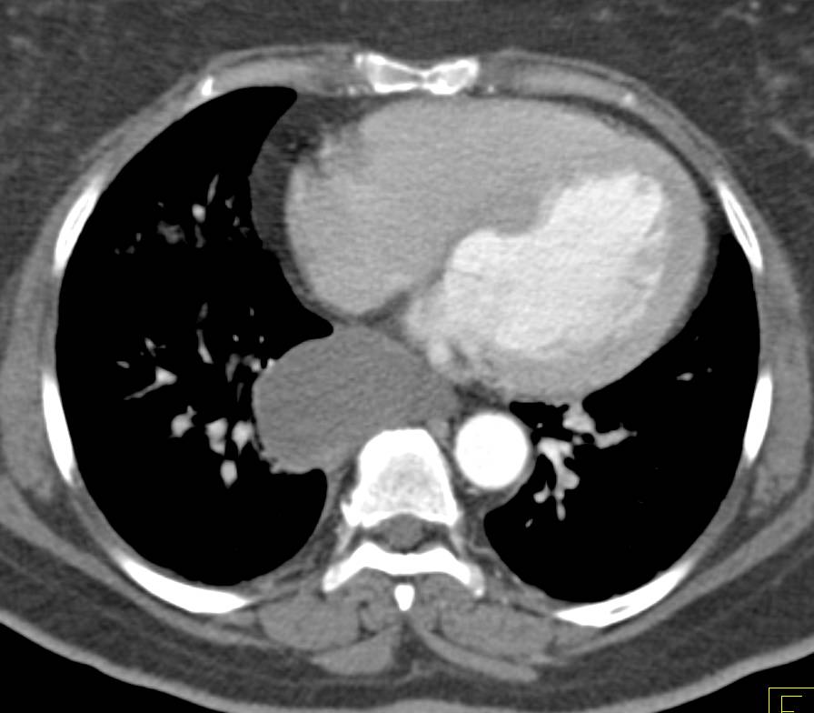 Duplication Cyst of the Esophagus - CTisus CT Scan