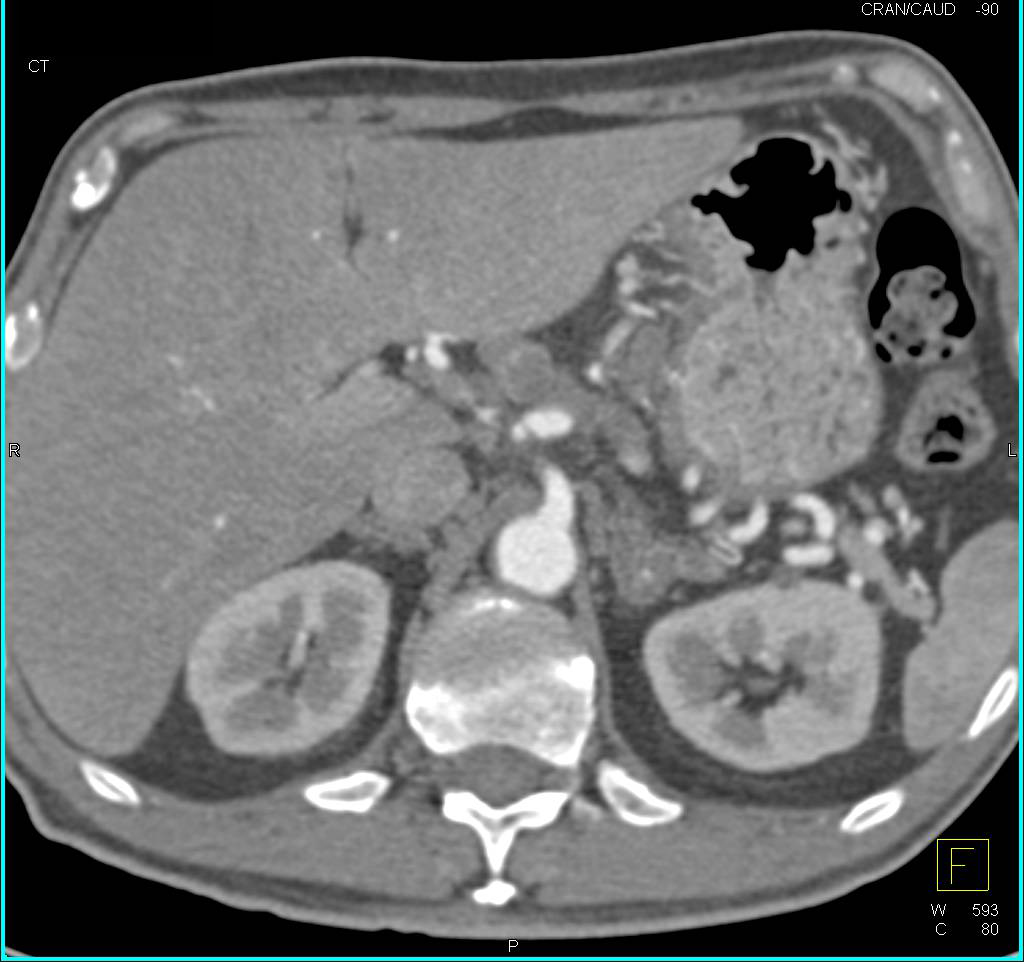 Esophageal Cancer with Stent and Celiac Adenopathy - CTisus CT Scan