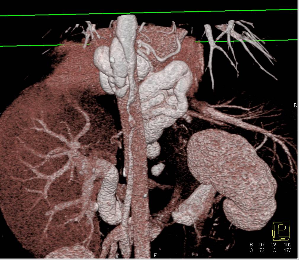 Large Esophageal Varices due to Portal Hypertension - CTisus CT Scan