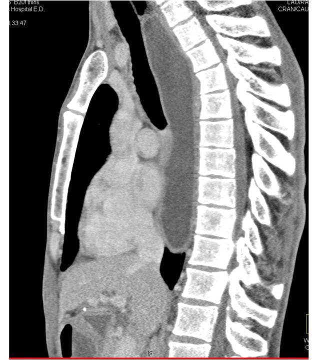Achalasia - CTisus CT Scan