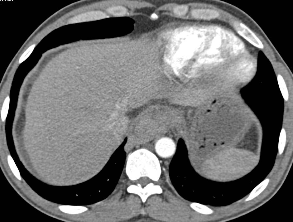 Incredible Esophageal Varices and Misty Mesentery in a Patient with Cirrhosis and Portal Hypertension - CTisus CT Scan