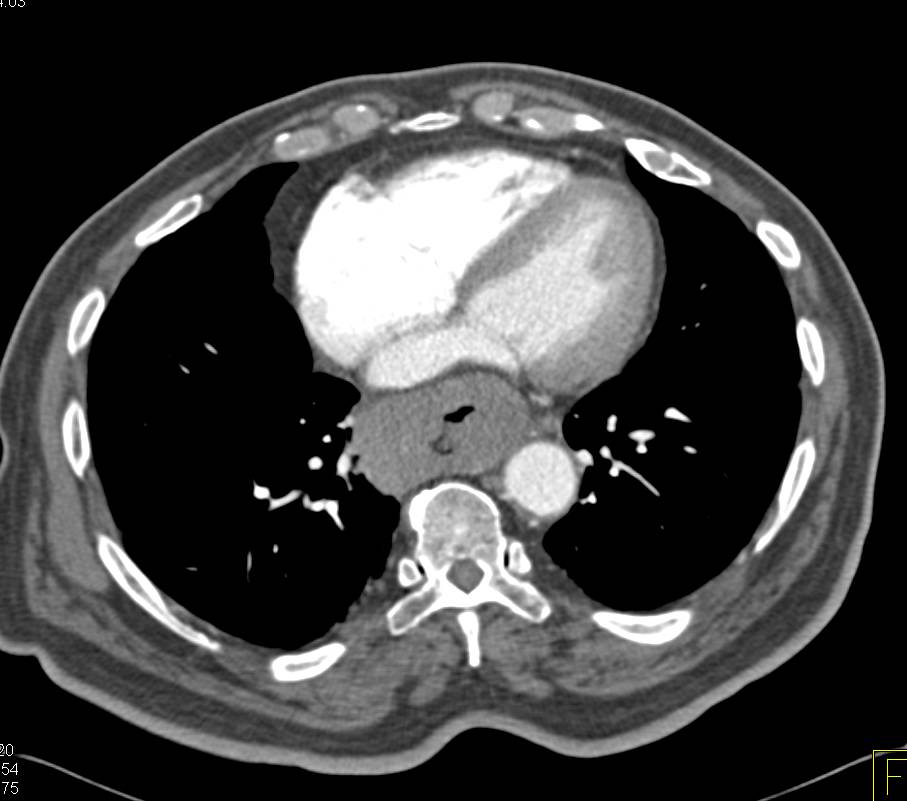 Carcinoma of the Lower Esophagus with Extensive Adenopathy - CTisus CT Scan