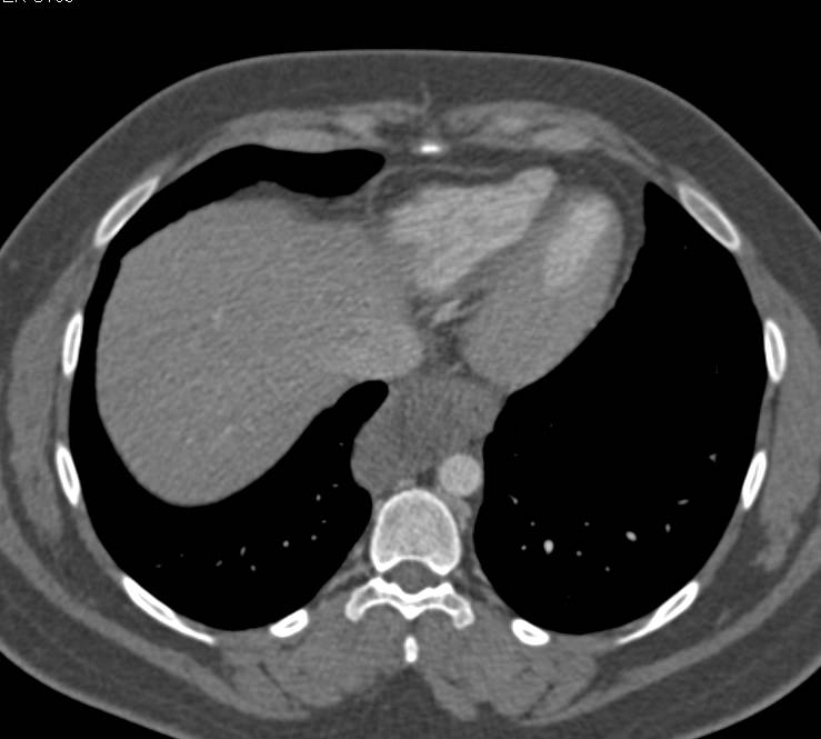 Esophageal Duplication Cyst - CTisus CT Scan