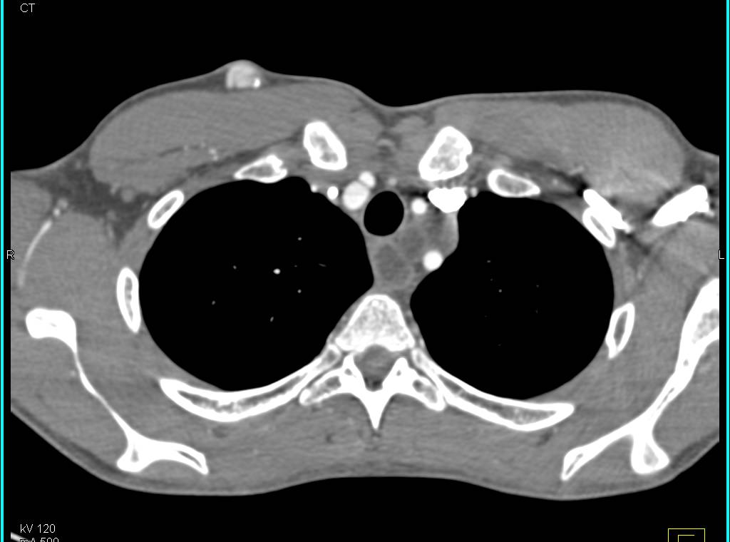 Mediastinal Germ Cell Tumor Involves the Esophagus with Adenopathy. Stent in Place. - CTisus CT Scan