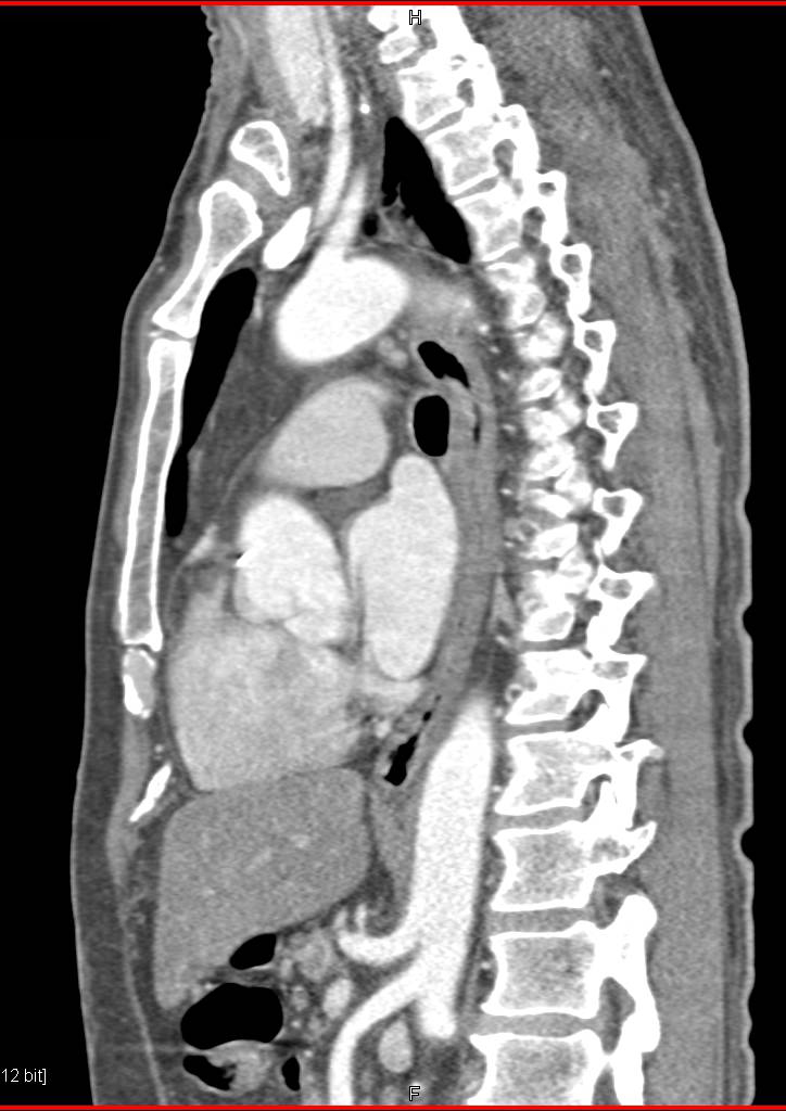Chest Pain Due to Severe Esophagitis - CTisus CT Scan