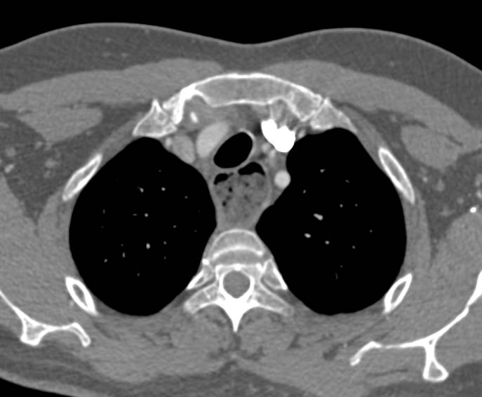 Achalasia - CTisus CT Scan
