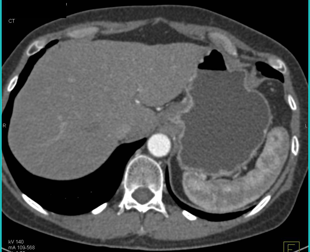 Adenocarcinoma at the EG Junction - CTisus CT Scan