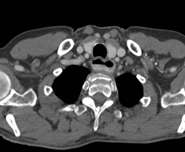 Achalasia - CTisus CT Scan