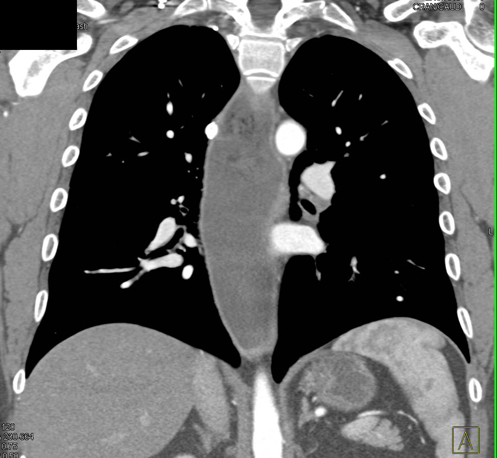 Achalasia with Dilated Esophagus - CTisus CT Scan