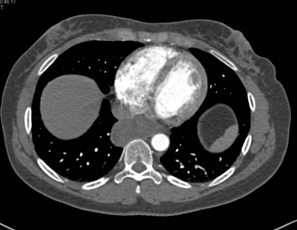 Esophageal Duplication Cyst - CTisus CT Scan