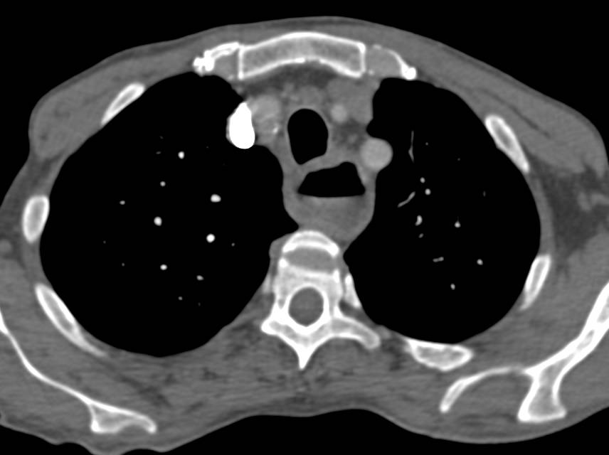 Achalasia - CTisus CT Scan