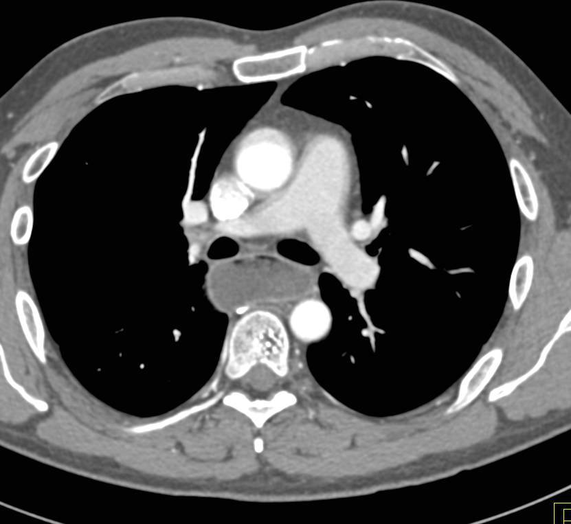 Achalasia - CTisus CT Scan