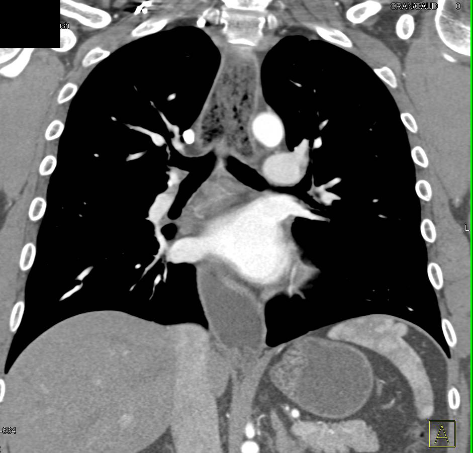 Dilated Esophagus due to Achalasia - CTisus CT Scan