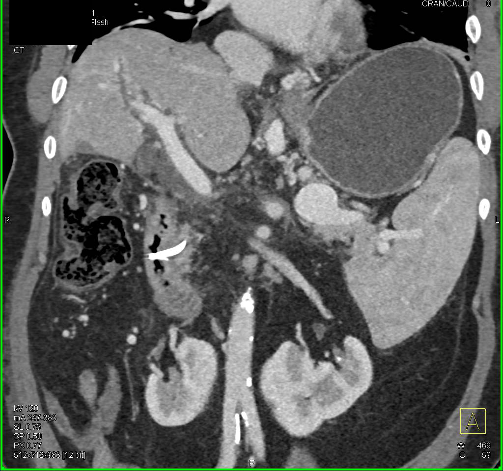 Large Esophageal and Gastric Varices due to Portal Hypertension - CTisus CT Scan
