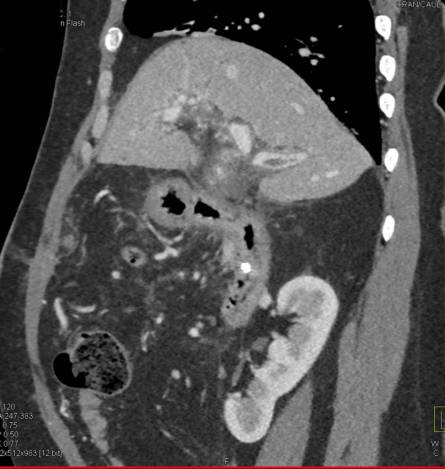 Large Esophageal and Gastric Varices due to Portal Hypertension - CTisus CT Scan
