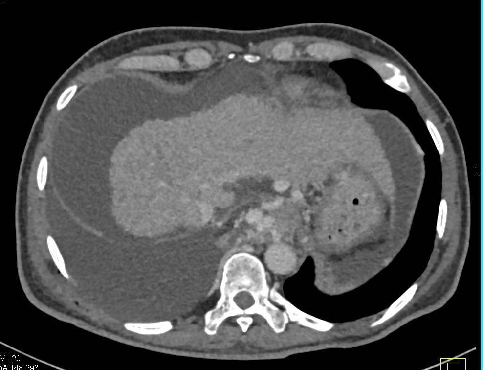 Cirrhosis with Large Esophageal Varices - CTisus CT Scan