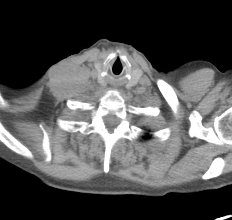 Esophageal Cancer with Positive Nodes on the PET/CT and CT - CTisus CT Scan