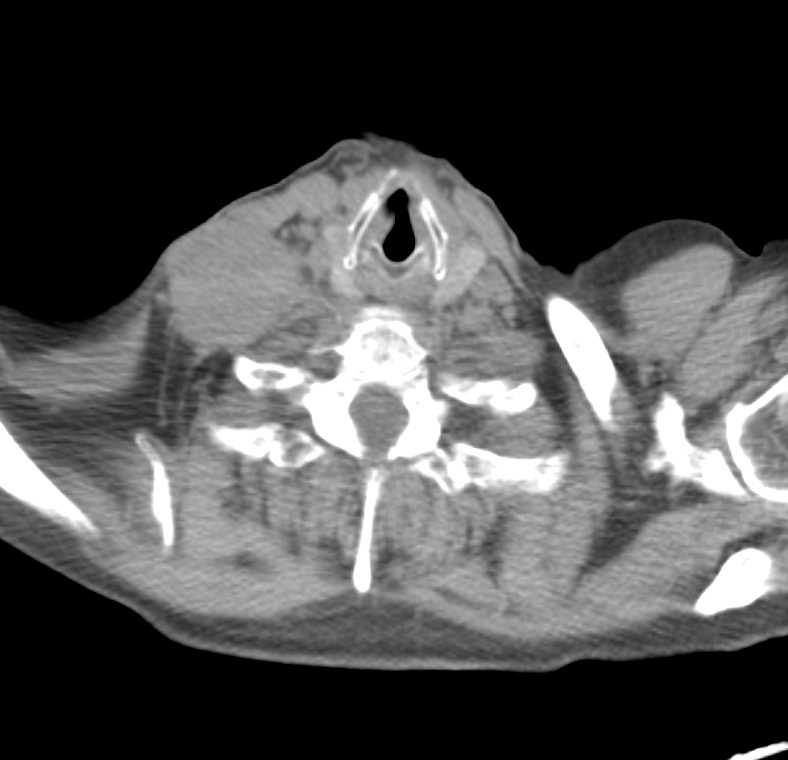 Esophageal Cancer with Positive Nodes on the PET/CT and CT - CTisus CT Scan