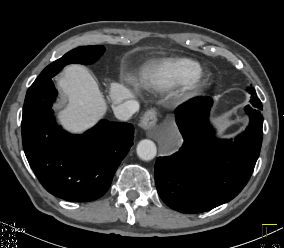Esophageal Duplication Cyst - CTisus CT Scan