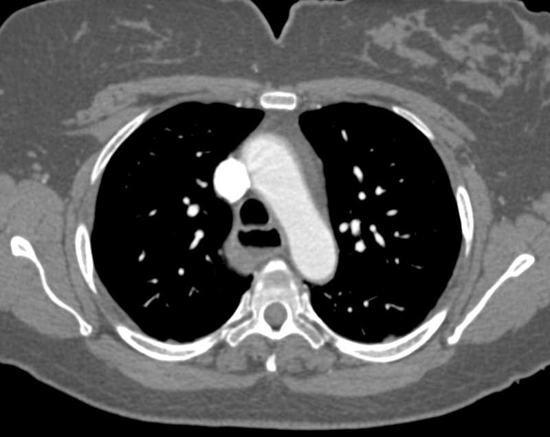 Achalasia - CTisus CT Scan