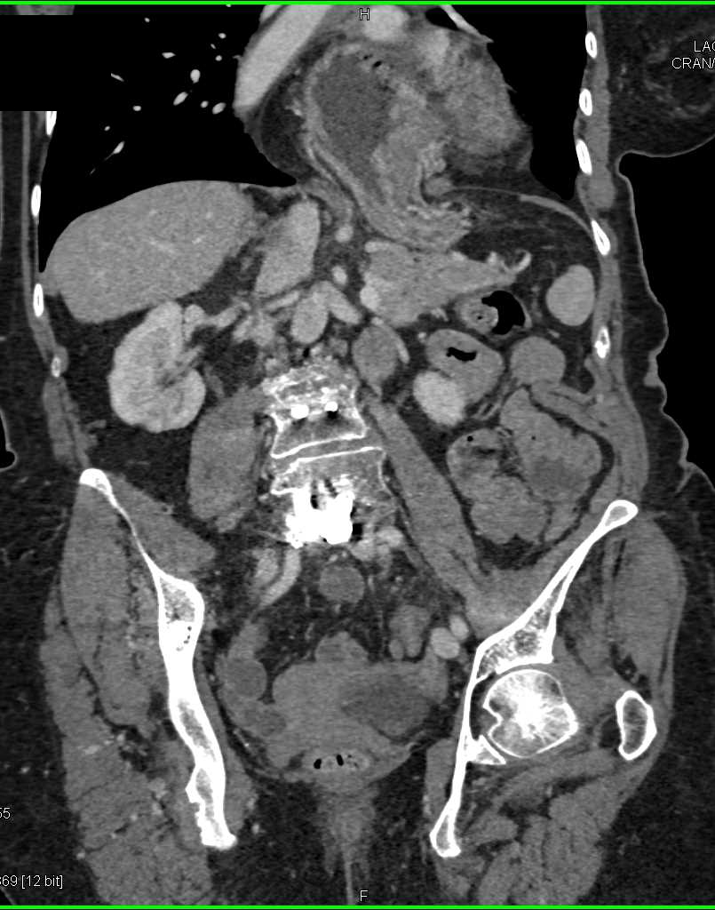 Large Paraesophageal Hiatal Hernia - CTisus CT Scan