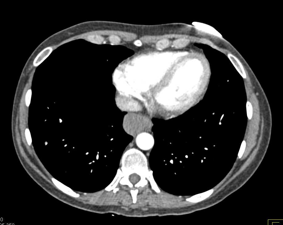Esophageal Cancer with Portocaval Adenopathy - CTisus CT Scan