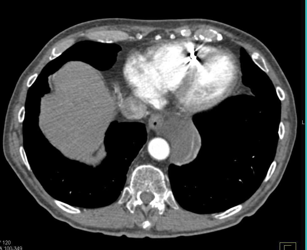 Esophageal Duplication Cyst - CTisus CT Scan