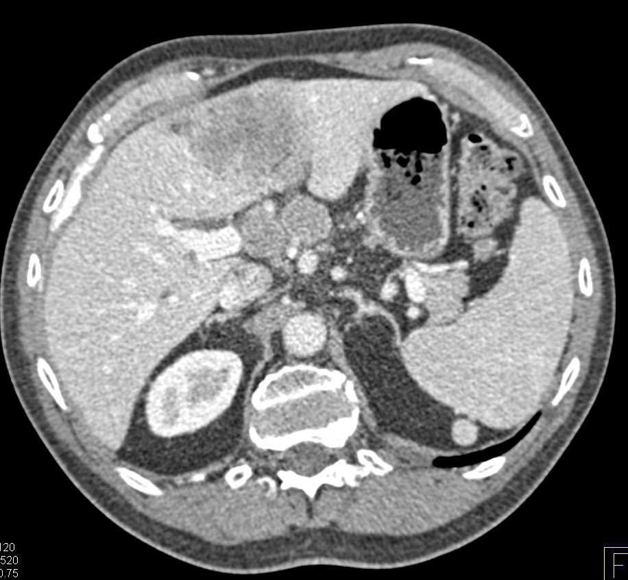 Metastatic Esophageal Cancer to Mediastinum, Nodes and Liver - CTisus CT Scan