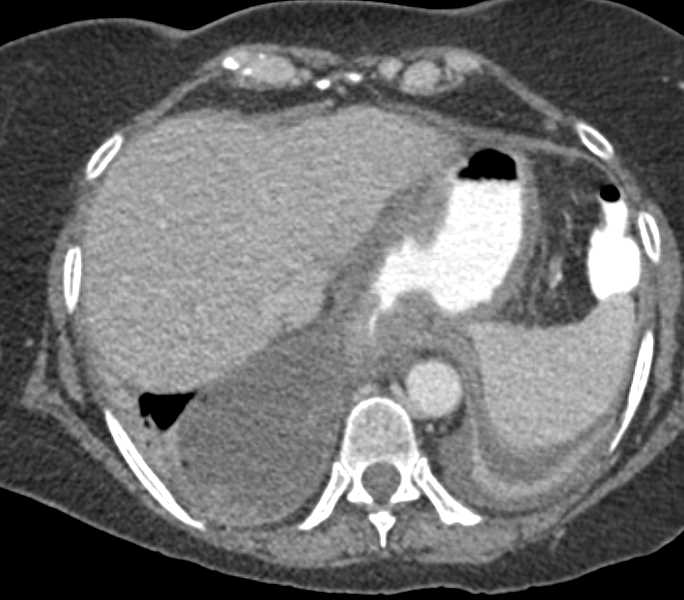 Reconstruction Surgery for Esophageal Bypass with Post Operative Changes - CTisus CT Scan
