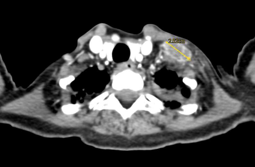 Esophageal Cancer with Widespread Metastases - CTisus CT Scan