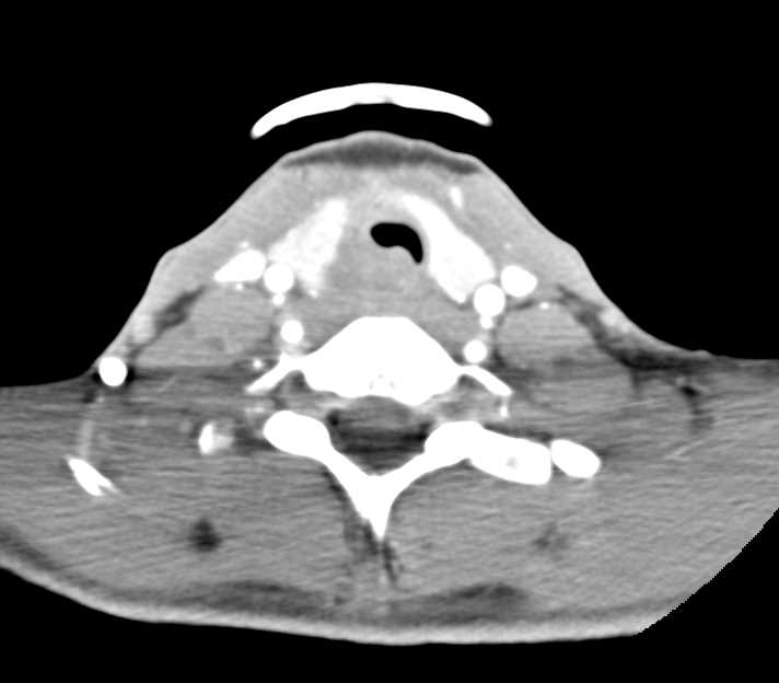 Esophageal Carcinoma - CTisus CT Scan
