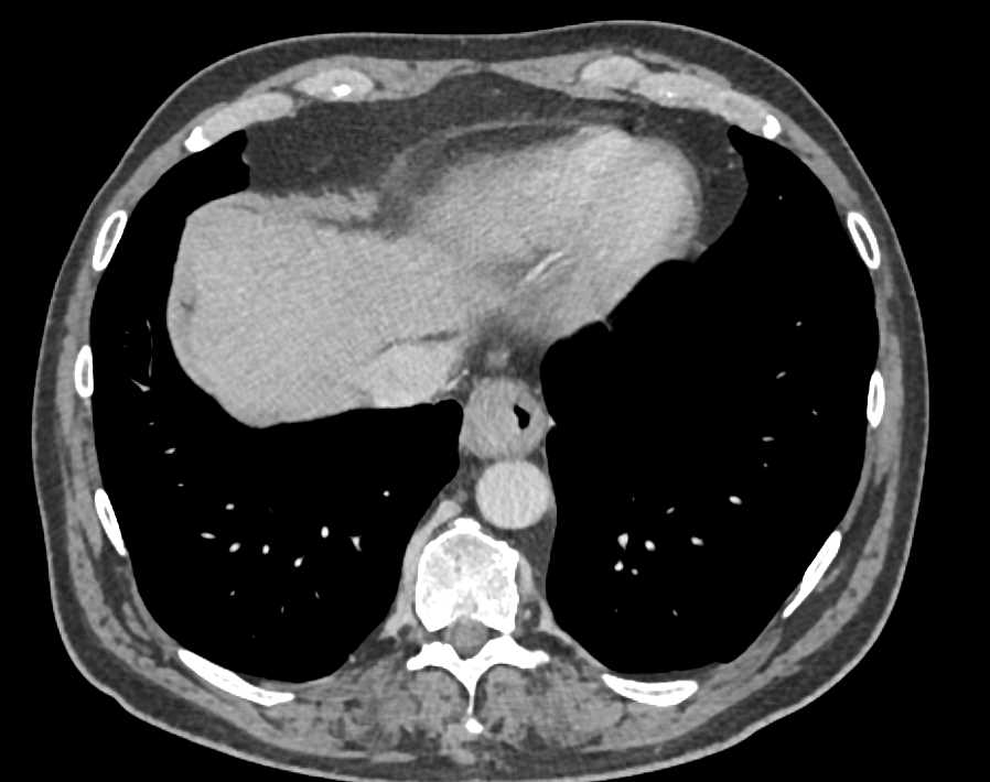Esophageal Cancer with Supraclavicular and Abdominal Adenopathy - CTisus CT Scan