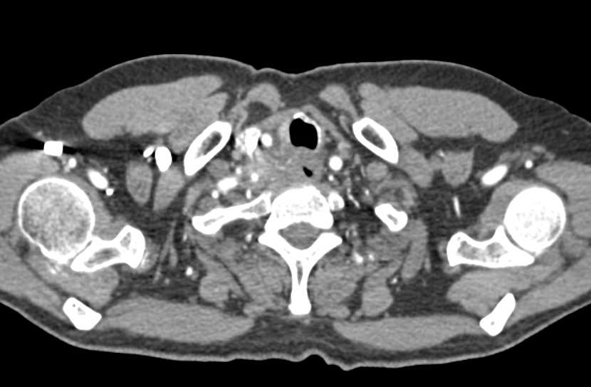 Invasive Esophageal Cancer with Tumor Implants - CTisus CT Scan