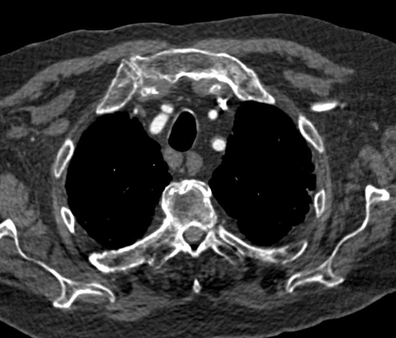 Subcrural Nodes from Esophageal cancer - CTisus CT Scan