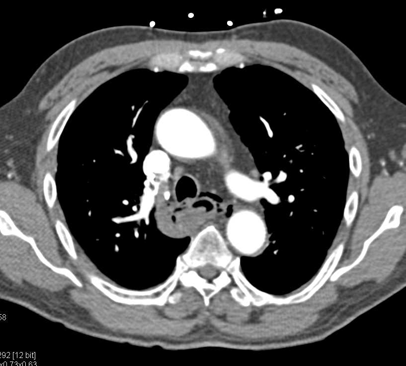 Esophageal Cancer Post Endoscopy with Perforation - CTisus CT Scan