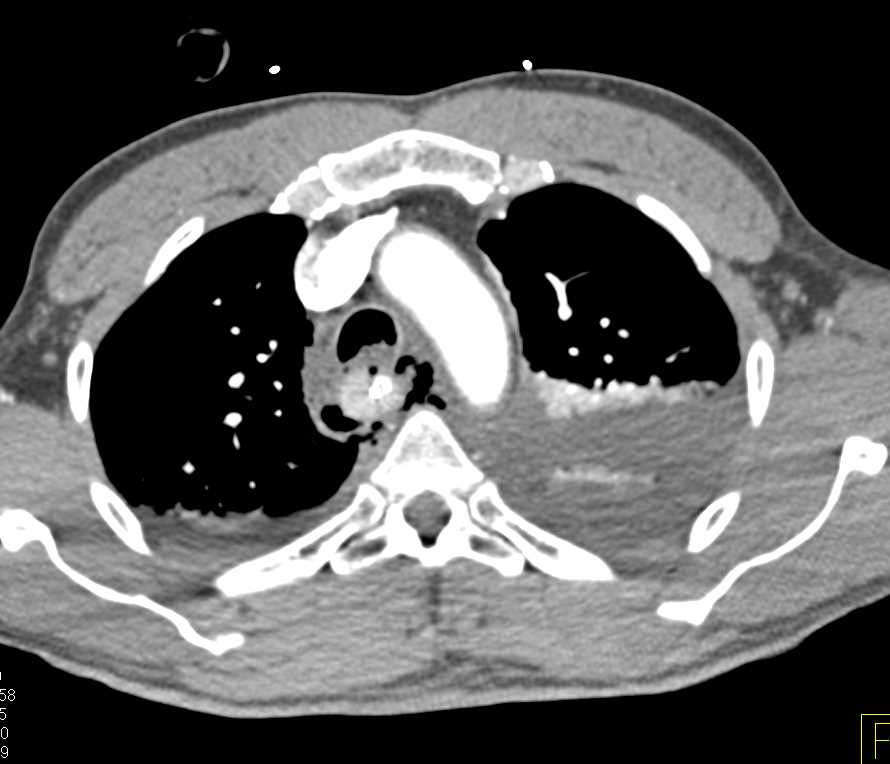 Esophageal Perforation - CTisus CT Scan