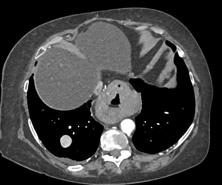 Esophageal Cancer Arises in a Hiatal Hernia - CTisus CT Scan