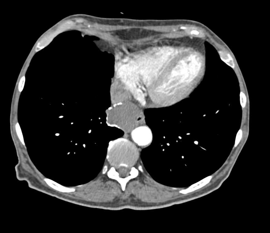 Esophageal GIST Tumor - CTisus CT Scan