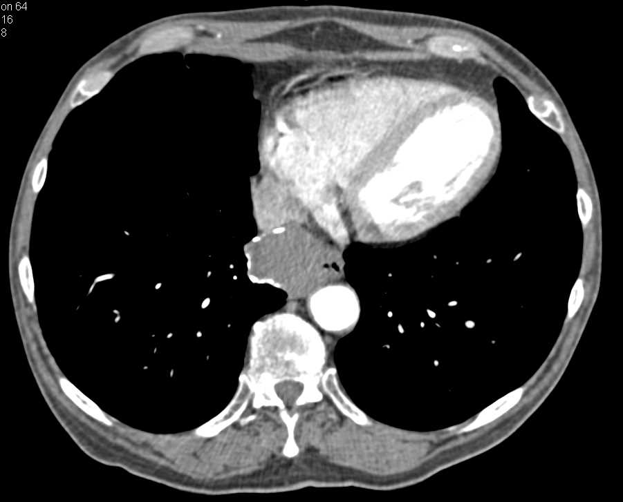 Leiomyoma Esophagus - CTisus CT Scan
