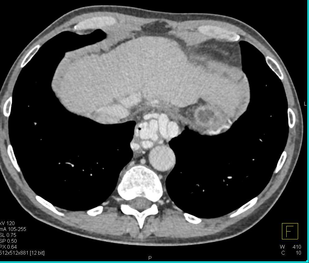Esophageal Varices - CTisus CT Scan