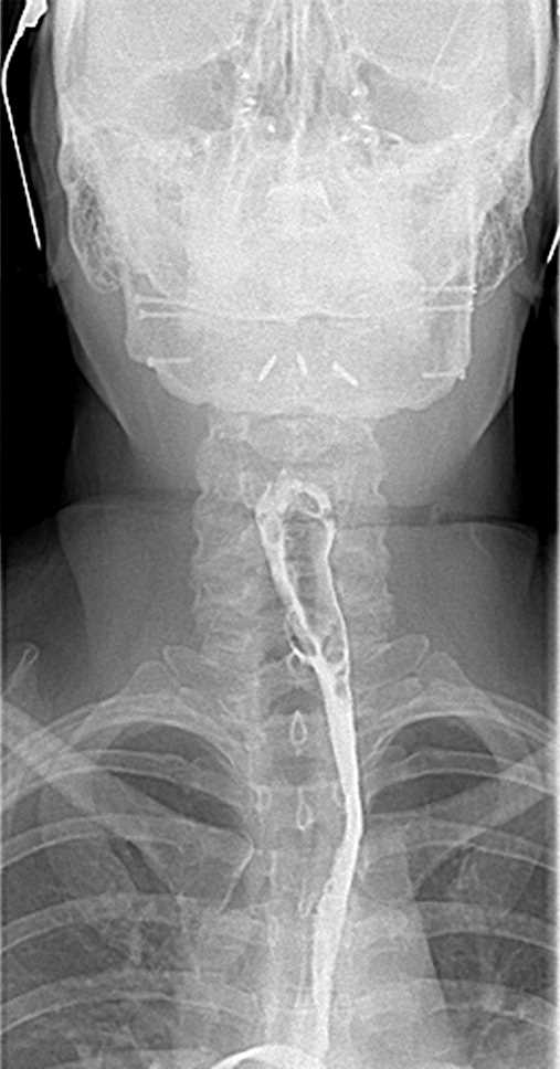 Perforated Esophagus due to Fishbone - CTisus CT Scan