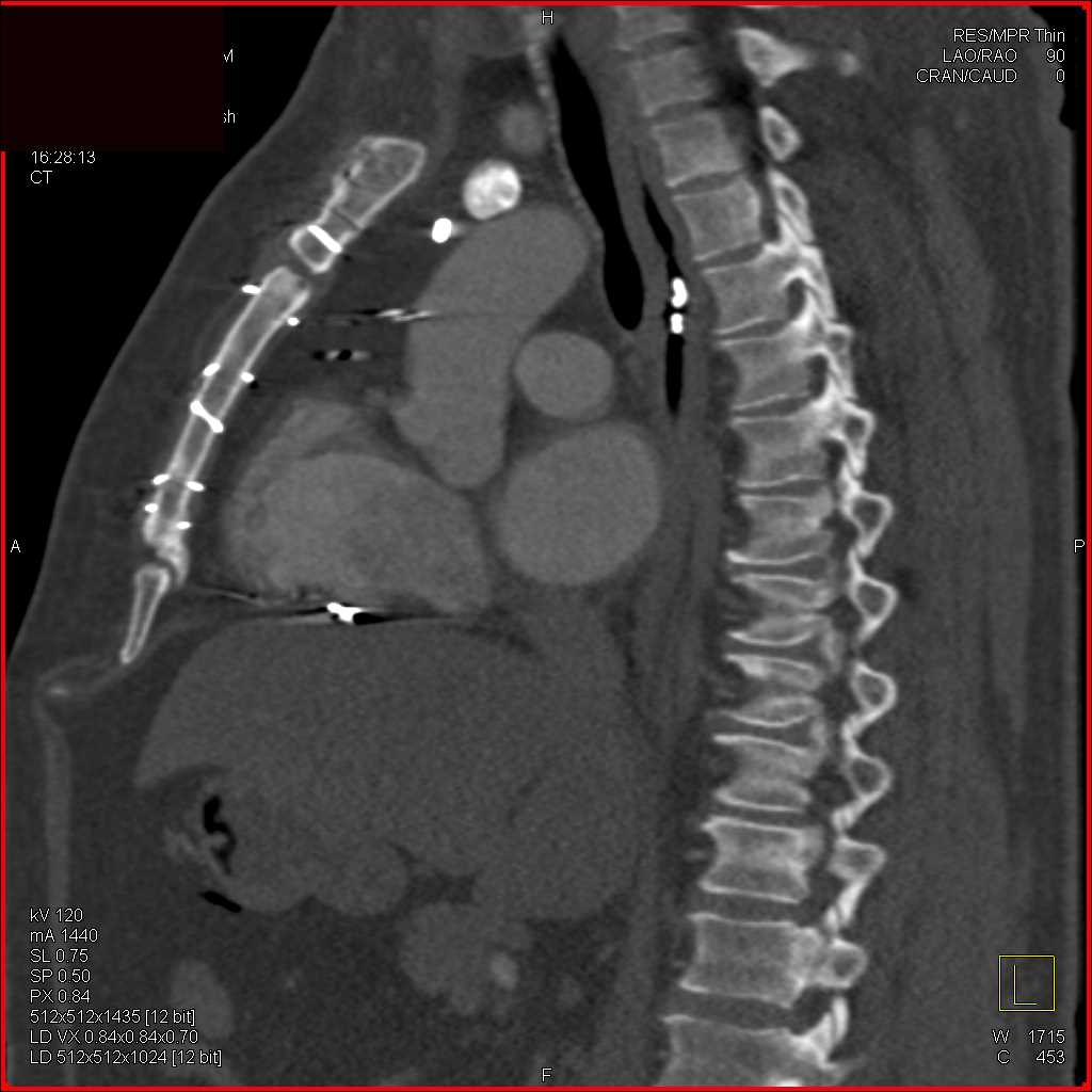 Monitoring Device in the Esophagus for PH - CTisus CT Scan