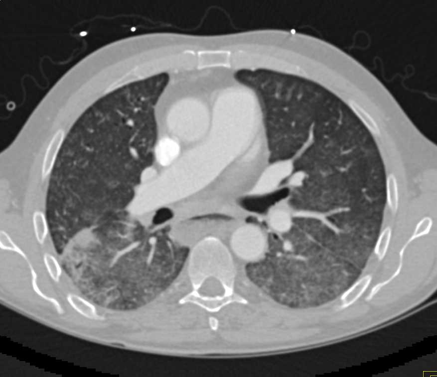 Achalasia with Increased Basilar Lung Markings - CTisus CT Scan