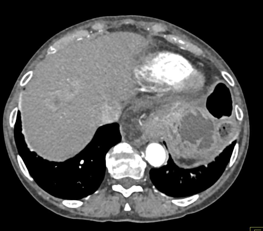 Esophageal cancer with Liver Metastases - CTisus CT Scan