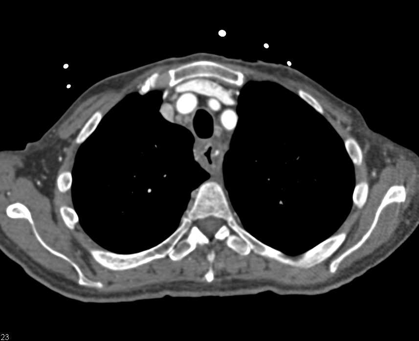 Esophageal Cancer with Stent - CTisus CT Scan